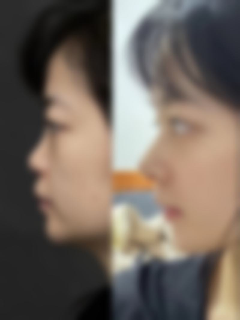 巴克对重度疤痕增生的局限性