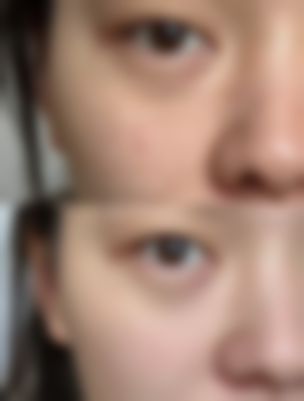 50岁女人眼袋怎么去除？日常护理、非手术医美与手术治疗各有招，选对方法很重要！ 