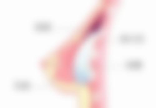 物理治疗疤痕疙瘩