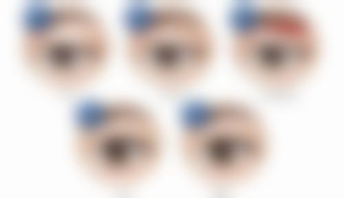 手术去眼袋的方法