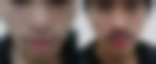 四、武汉大麦微针植发特色项目