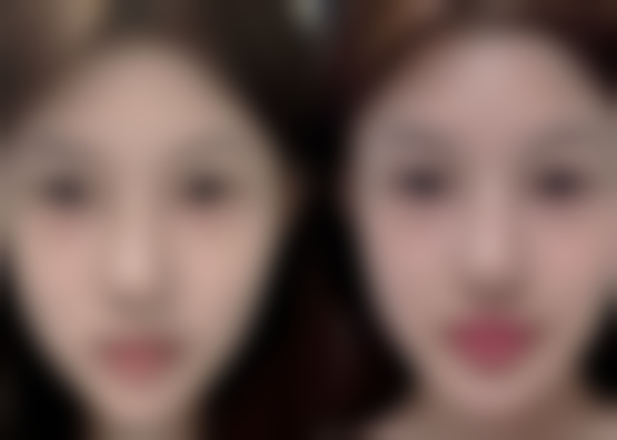 吸脂丰胸可能引发的其他坏处