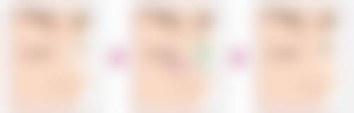 术后维持:巩固成效,保持眼部年轻