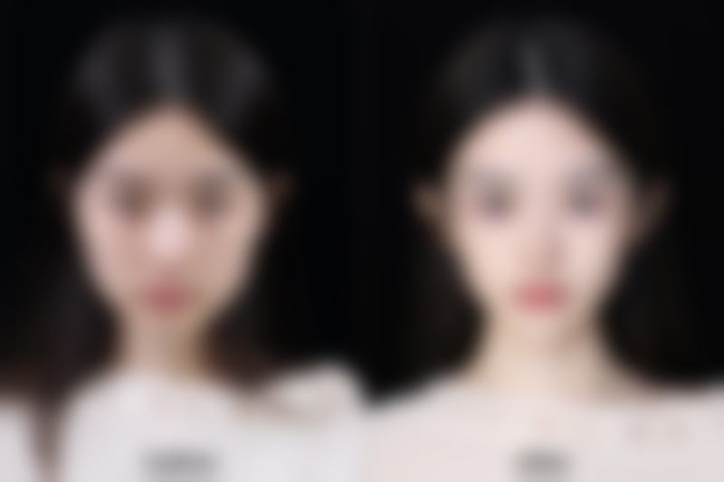 影响烫伤疤痕去除成效的因素