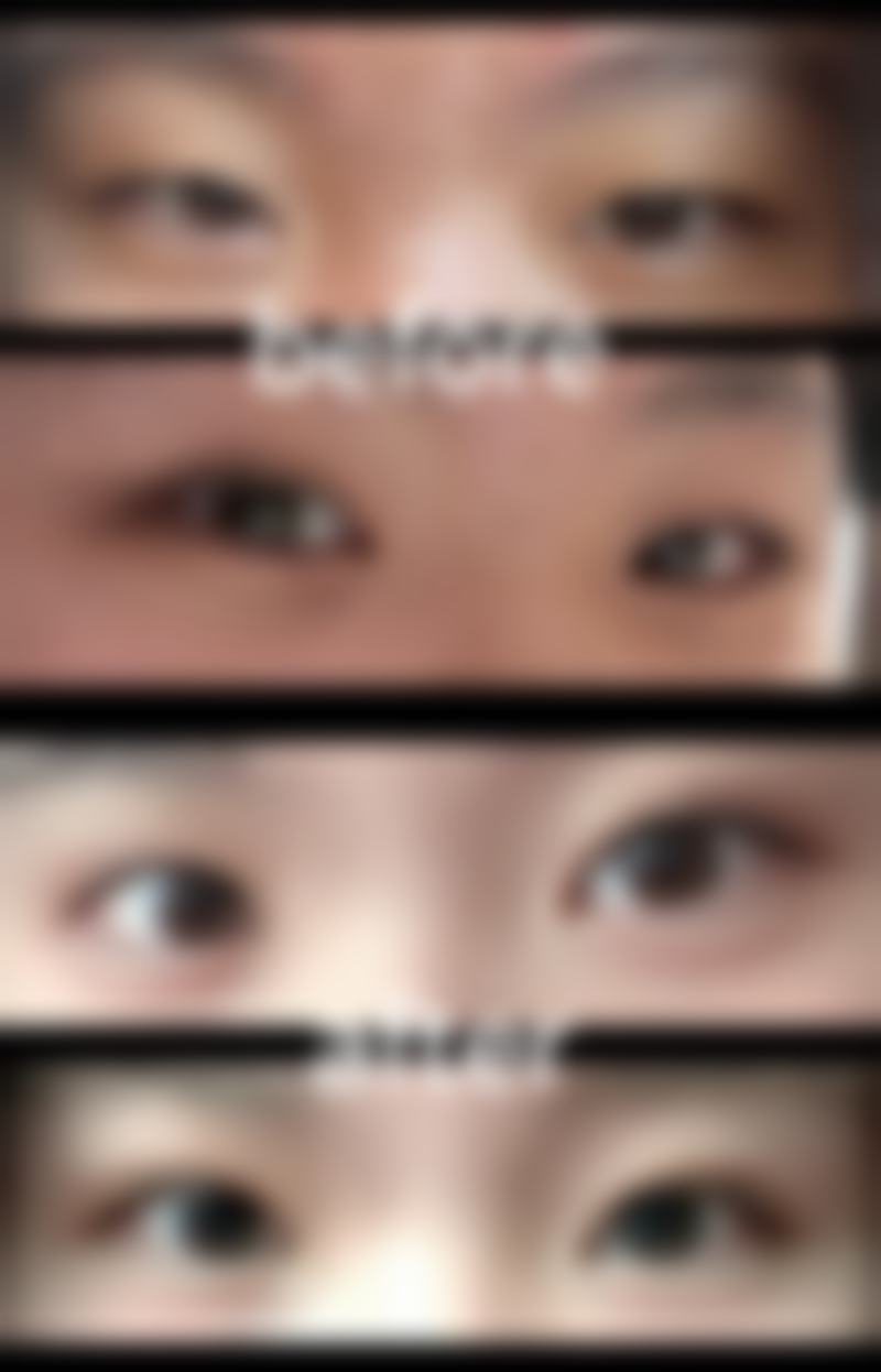 药物治疗:借助药物,缓解眼袋问题