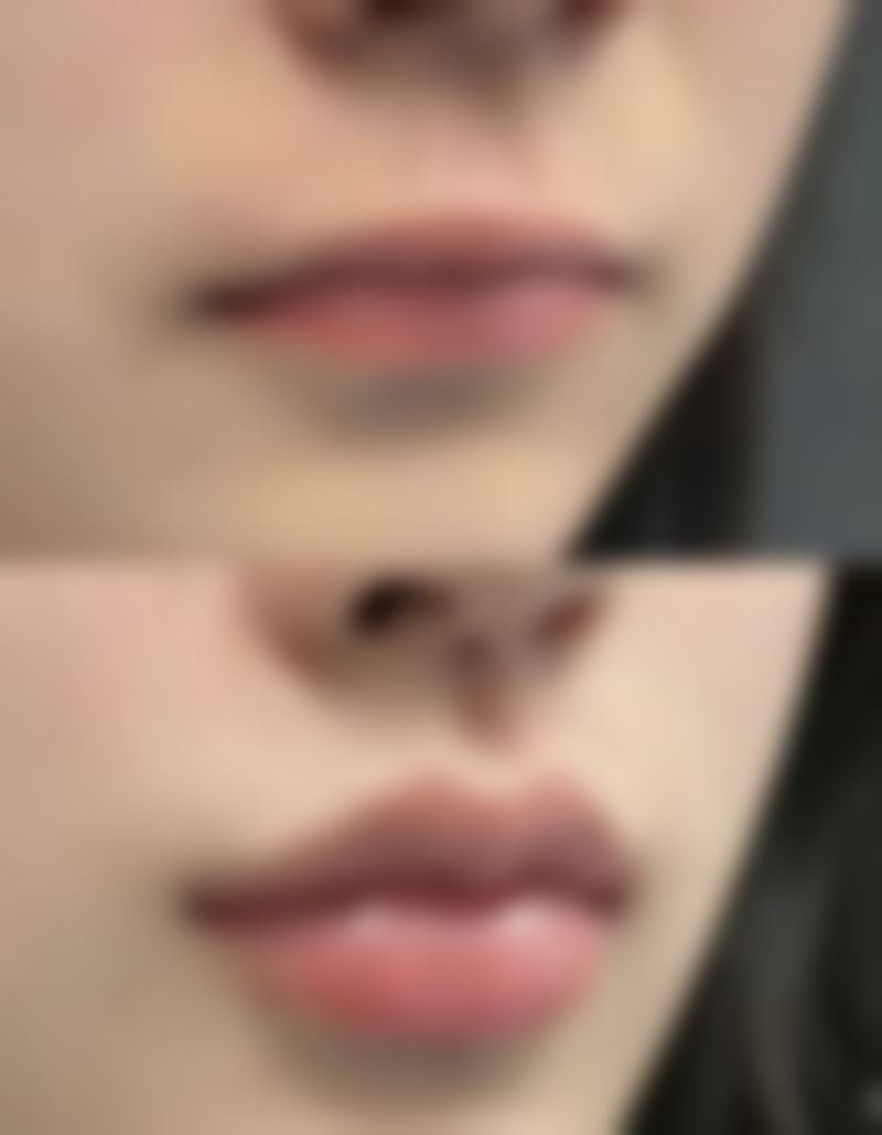 冰黄瓜对不同类型眼袋的作用