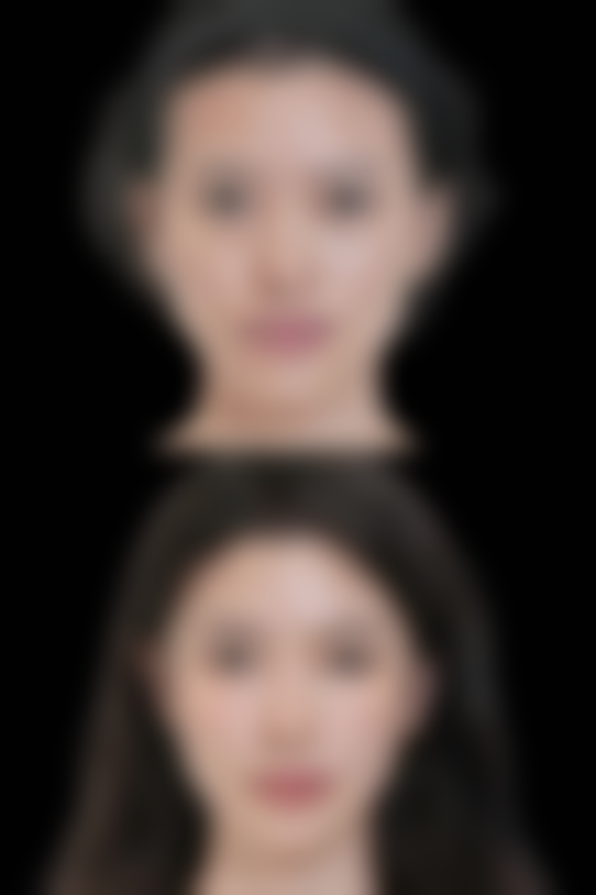 不同时期取出线提升隆鼻的难度差异