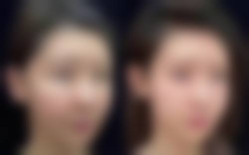 刚做完双眼皮缝线处有个褶皱怎么办？可观察等待或采取物理、药物等方法，严重时需手术修复！ 