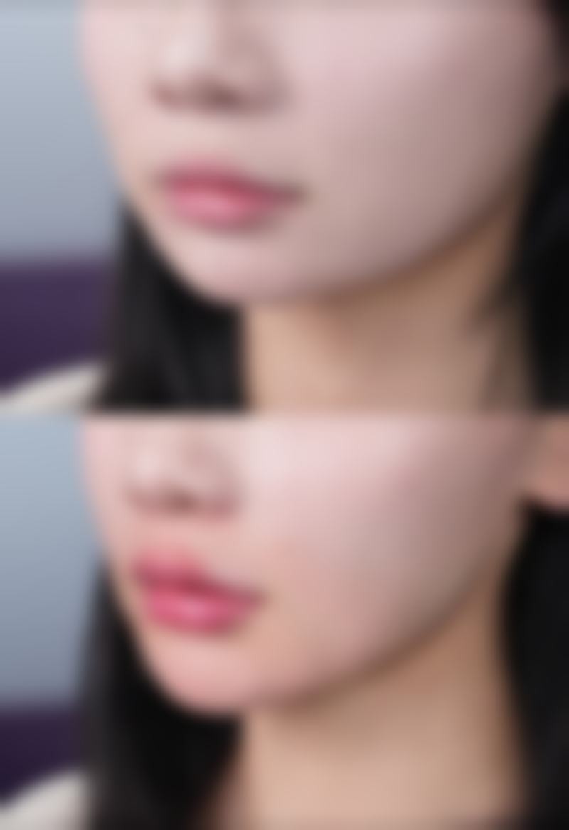 十几年疤痕的特点及激光治疗的挑战