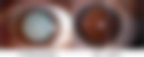 隆鼻做哪种比较安全？注射、假体、自体软骨及线雕隆鼻各有优劣，选对方式很重要！ 