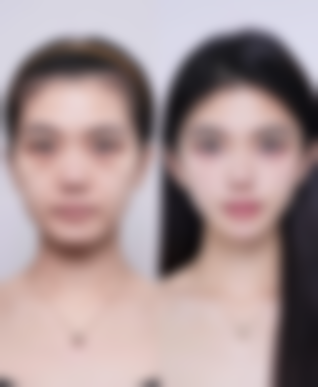 隆胸术前术后的注意事项