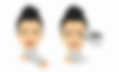 外切法去眼袋：全方面改善眼部问题的“高能选手”