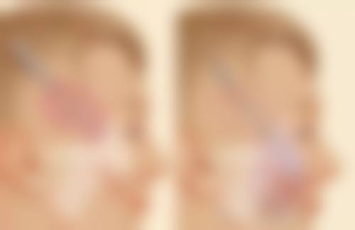 促进疤痕凹陷修复的方法