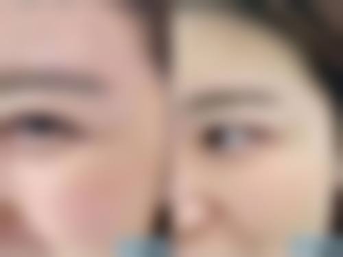 面部吸脂术的适应人群与禁忌人群