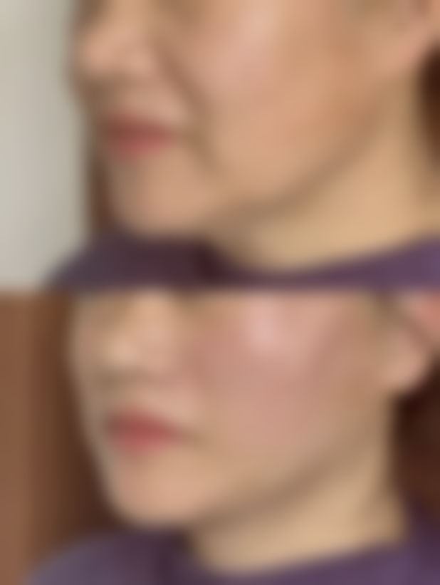 不同隆鼻术式的修复差异