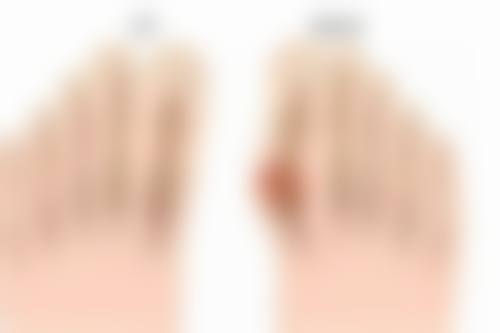 日常护理：辅助烫伤疤痕修复