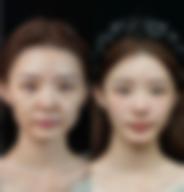 做完双眼皮眼睛磨怎么回事？可能是生理反应、感染、操作不当等原因，教你应对办法！ 