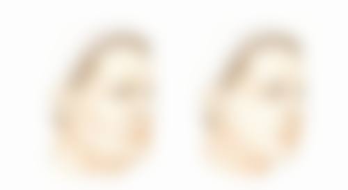 常见的凹性疤痕治疗方法