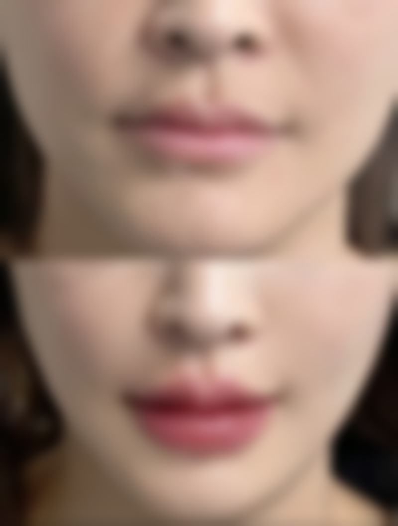 通用的疤痕治疗疗法