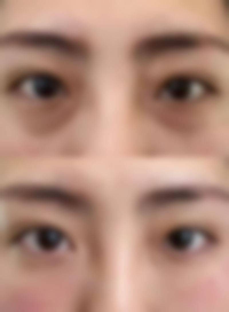 硅胶隆鼻多久才会恢复？恢复时间受多因素影响，多数人2 - 3个月完全恢复，护理要点要记牢！ 