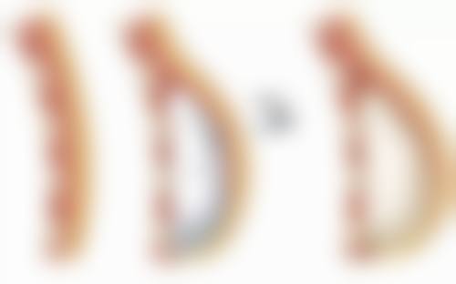 内切去眼袋有什么副作用？可能出现出血血肿、感染、下睑问题等，了解详情防患未然！ 