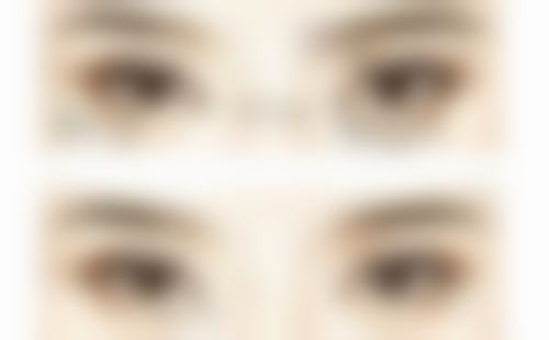 什么时间做眼袋手术好？需从年龄、单日、季节、特殊时期等多维度考量，结合自身综合选！ 