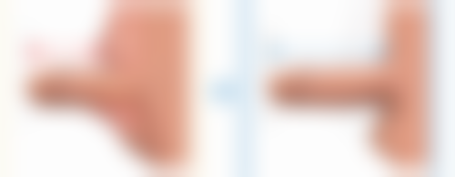 腹部创伤——意外带来的子宫伤害