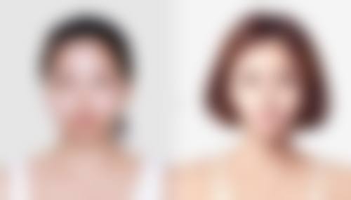 激光祛眼袋手术：非手术的选择