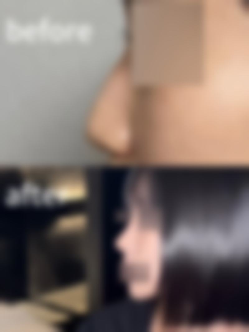 打了瘦脸针脸上凹凸修复的注意事项