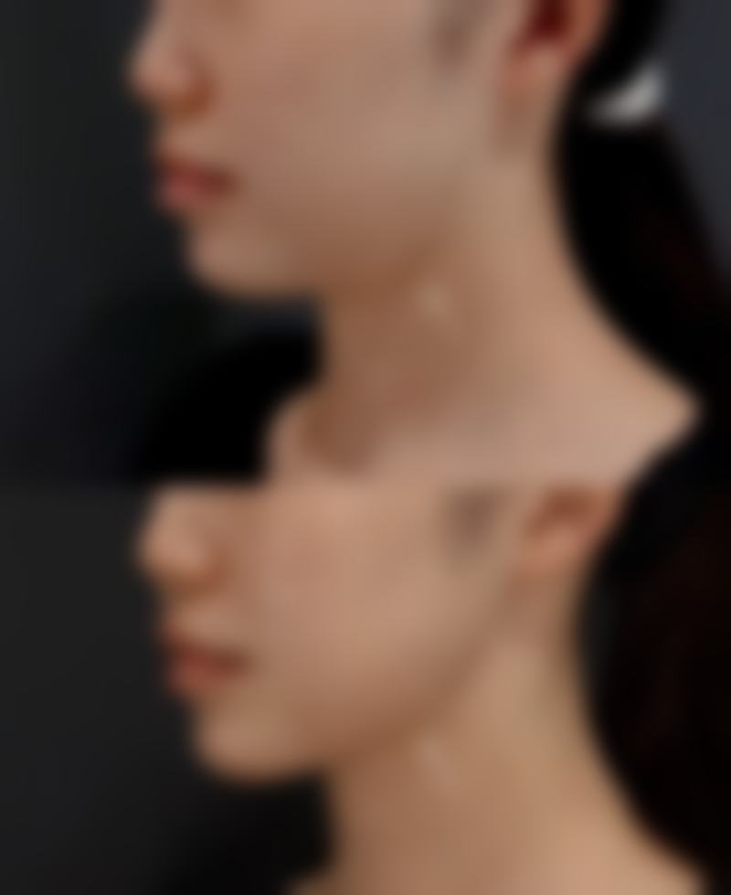 打了瘦脸针脸上凹凸怎么办？可采取保守、填充、手术等治疗，遵循注意事项促恢复！ 