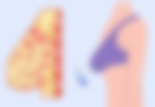 物理治疗改善皮肤上的疤痕