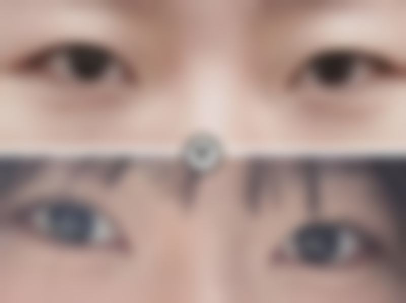 手术治疗去除重度的皮肤上疤痕