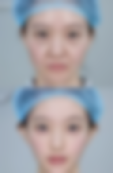 国产瘦脸针怎么样？效果、适用场景、价格、安全性全解析，与进口对比优势尽显！ 