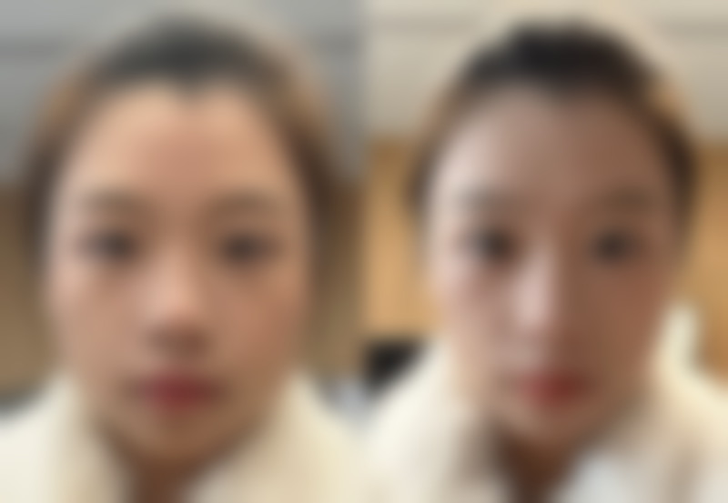 国产瘦脸针的安心性保护