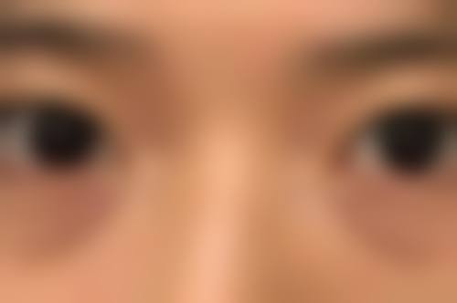 用自己脂肪隆胸的缺点