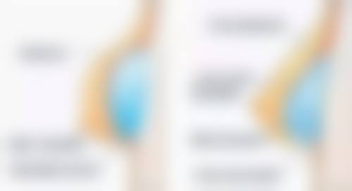 如何选择适合自己的隆胸方式