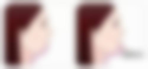 怎么才能让内双变成双眼皮？非手术临时和手术永久方式各有妙招，专业建议来助力！ 