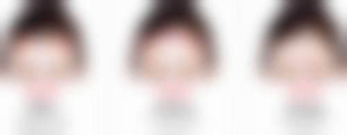 提眉祛眼袋多久恢复？基本1 - 3个月自然，3 - 6个月正常，受体质、术式和护理影响！ 