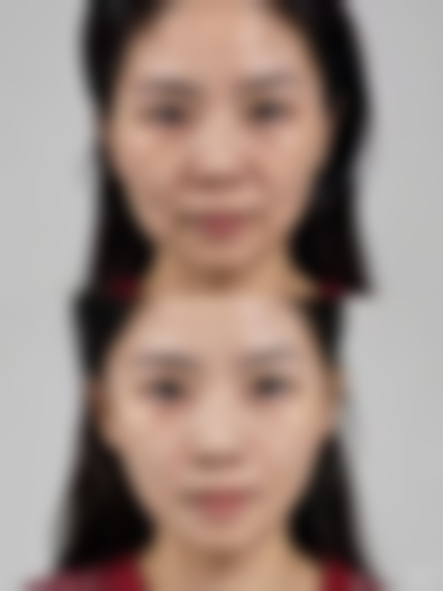 洗眉疤痕去除后的护理要点