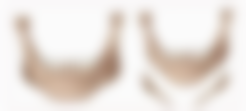 长期缝线问题造成多层双