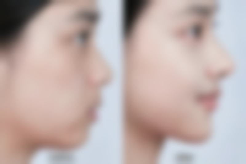 影响切眼袋修复时间的因素