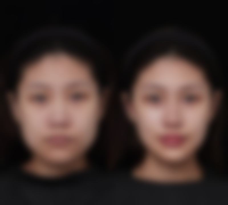 适合做开扇形双眼皮的眼部特征