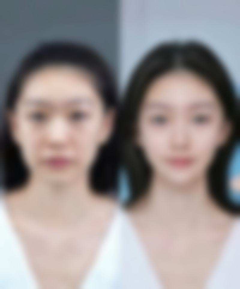 过敏因素：过敏反应引发的眼袋危机