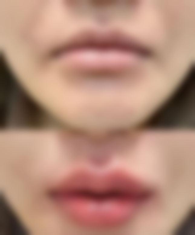 微创拉皮除皱方法