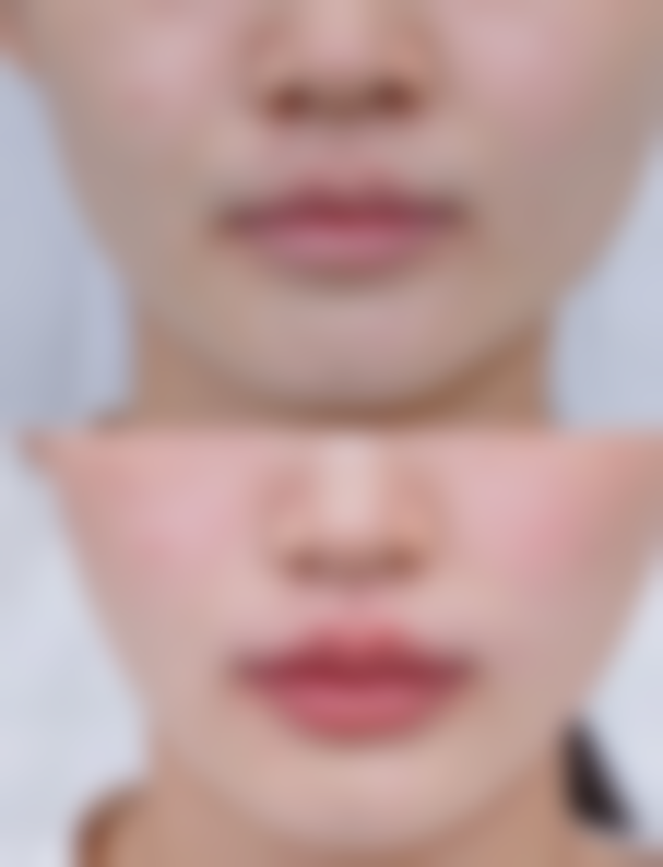 科学有效的去眼袋方法