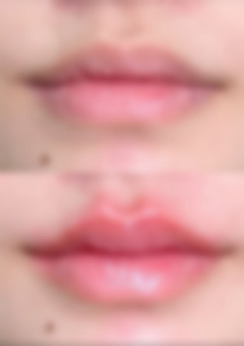 不同品牌瘦脸针对修复时间的影响