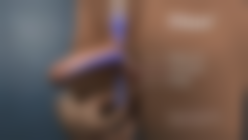 中医疗疗疤痕疙瘩的局限性