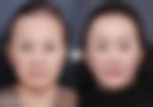 脸上破皮怎么不留疤痕？从伤口处理到愈合护理，再到疤痕干预，全流程指南来了！ 