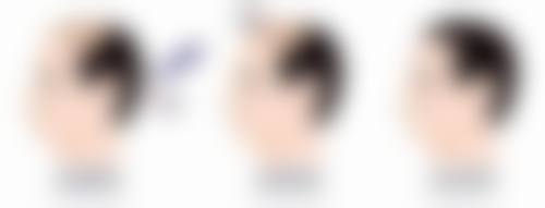 割双眼皮换身份证需要什么证明？容貌变化小无需证明，变化大需基础材料及整容手术证明等！ 