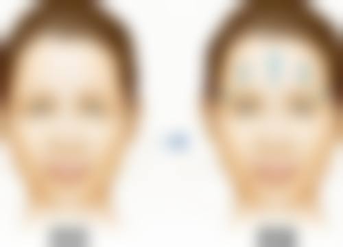 哪种去眼袋比较好？手术、激光、按摩等方法各有特点，选对方法轻松告别眼袋！ 